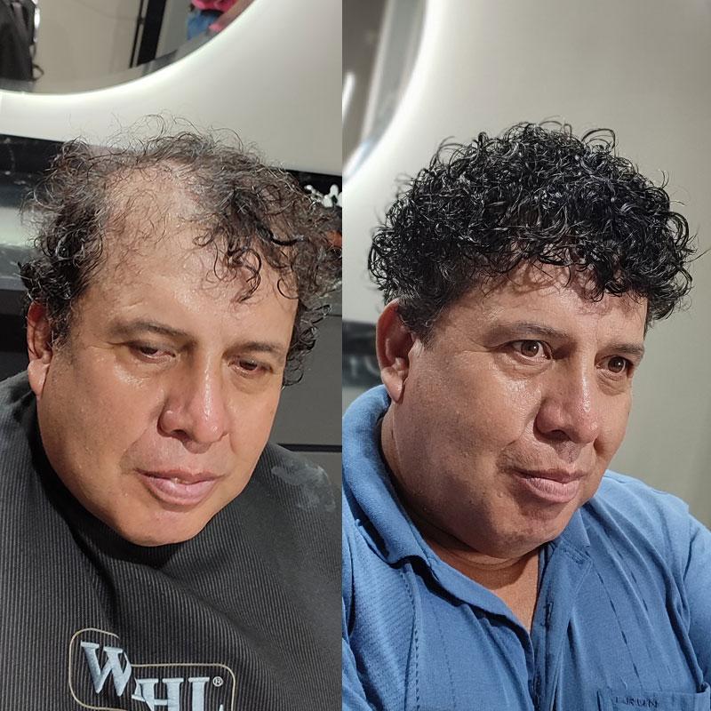 Hair System Before After Image