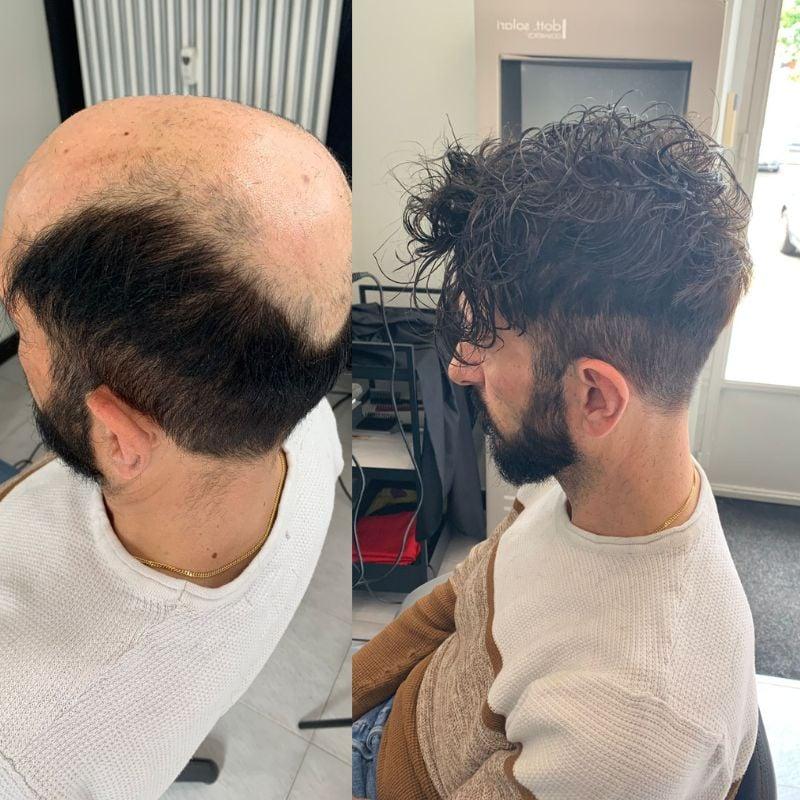 Hair System Before After Image