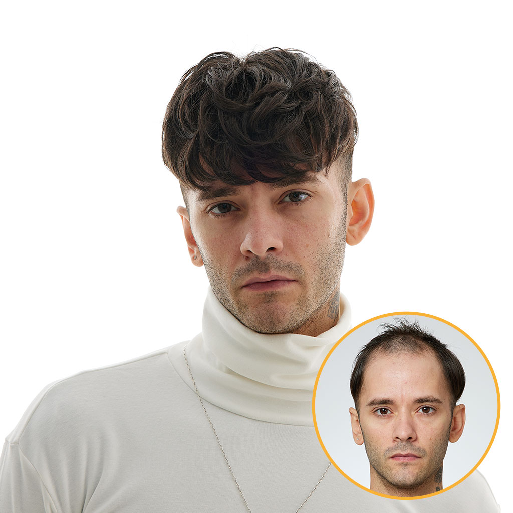 HS27 Fine Mono Hair System with Skin Gauze Front (8)
